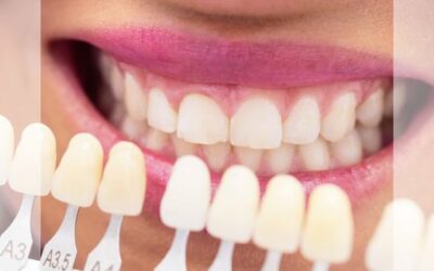 Tres cosas que debes tener en cuenta al hacerte un blanqueamiento dental: