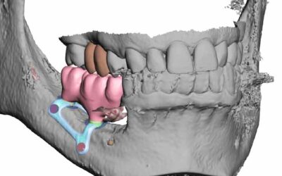 El papel de los implantes subperiósticos hechos a medida para Rehabilitación de mandíbulas atróficas: informe de un caso
